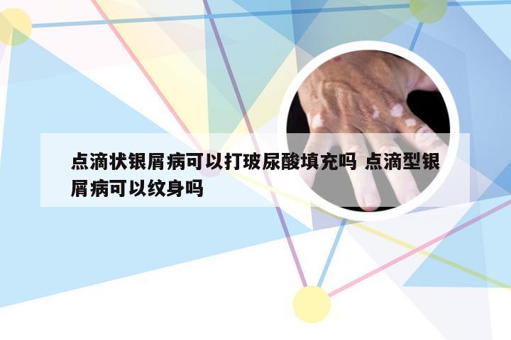 点滴状银屑病可以打玻尿酸填充吗 点滴型银屑病可以纹身吗