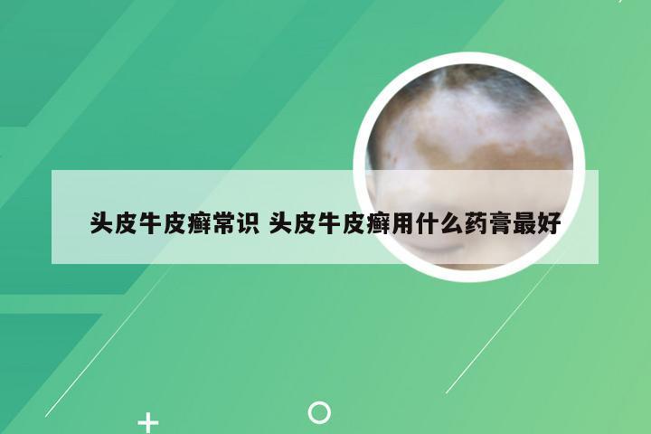 头皮牛皮癣常识 头皮牛皮癣用什么药膏最好