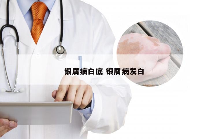 银屑病白底 银屑病发白