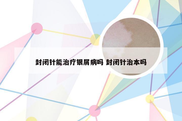 封闭针能治疗银屑病吗 封闭针治本吗