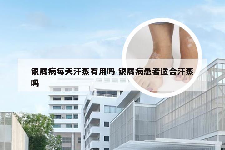 银屑病每天汗蒸有用吗 银屑病患者适合汗蒸吗