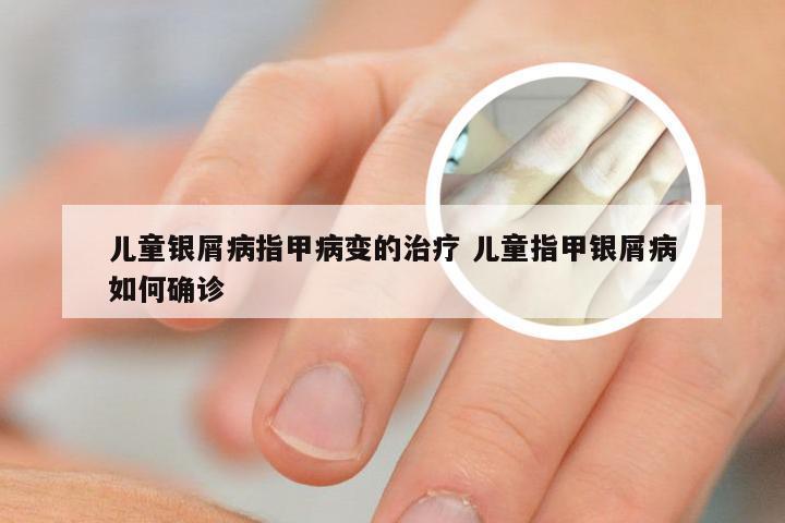 儿童银屑病指甲病变的治疗 儿童指甲银屑病如何确诊
