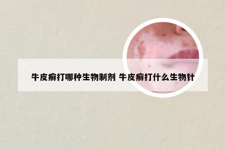 牛皮癣打哪种生物制剂 牛皮癣打什么生物针