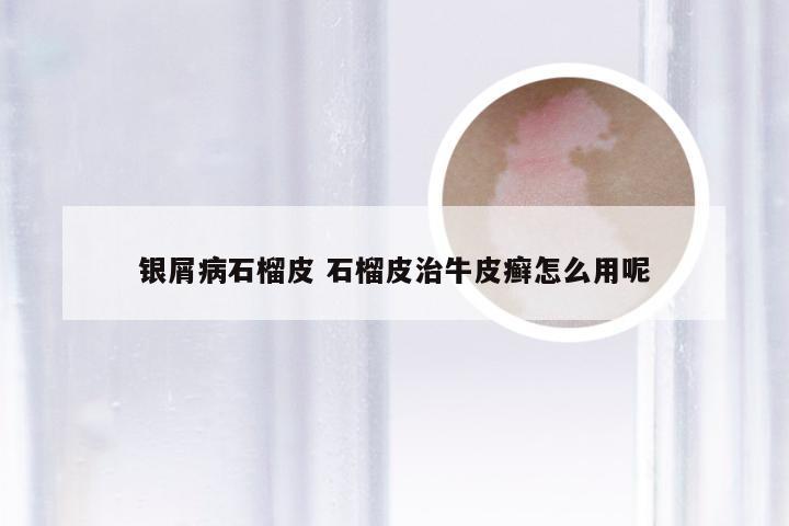 银屑病石榴皮 石榴皮治牛皮癣怎么用呢