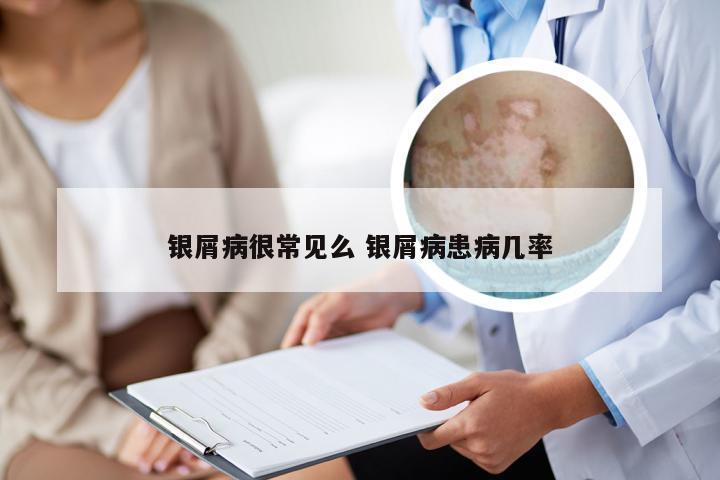 银屑病很常见么 银屑病患病几率