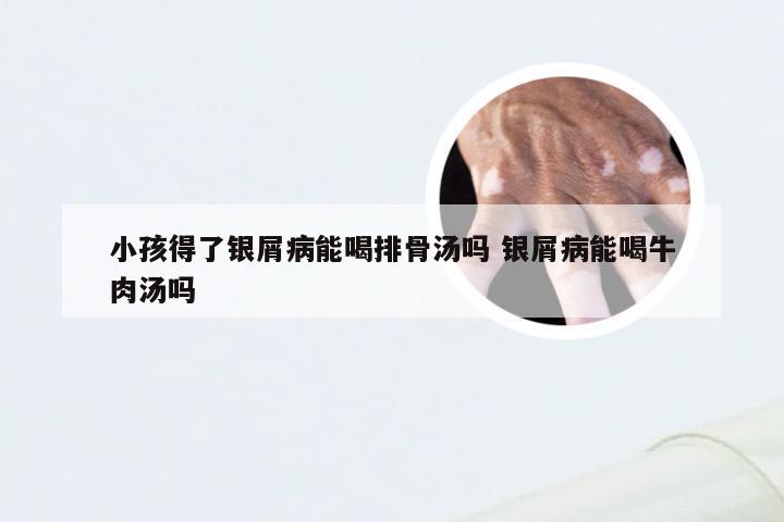 小孩得了银屑病能喝排骨汤吗 银屑病能喝牛肉汤吗