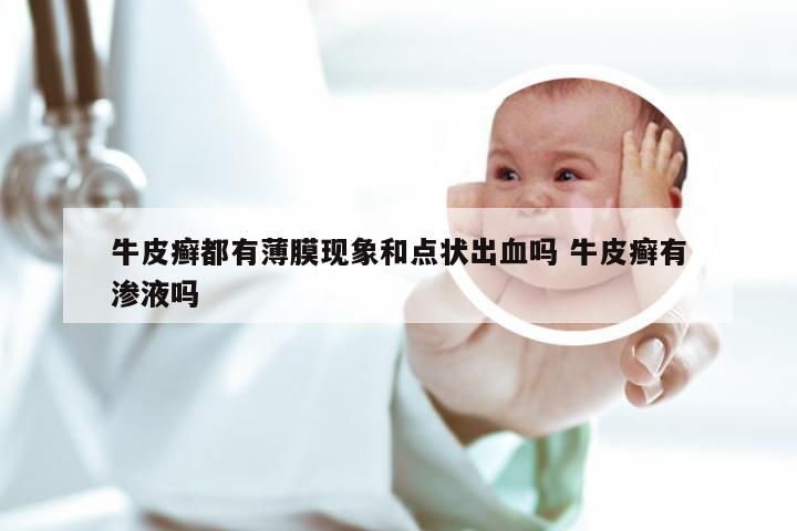 牛皮癣都有薄膜现象和点状出血吗 牛皮癣有渗液吗