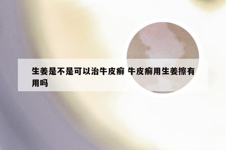 生姜是不是可以治牛皮癣 牛皮癣用生姜擦有用吗