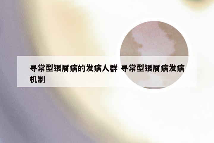 寻常型银屑病的发病人群 寻常型银屑病发病机制