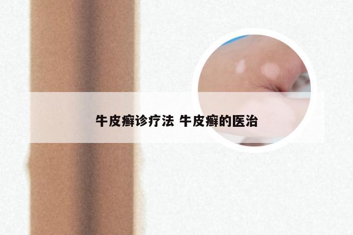 牛皮癣诊疗法 牛皮癣的医治