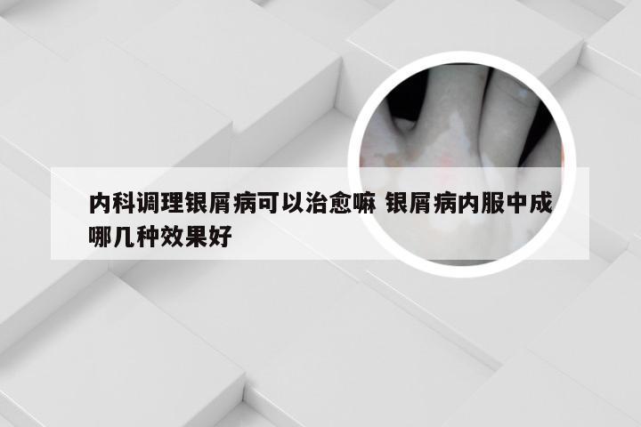 内科调理银屑病可以治愈嘛 银屑病内服中成哪几种效果好