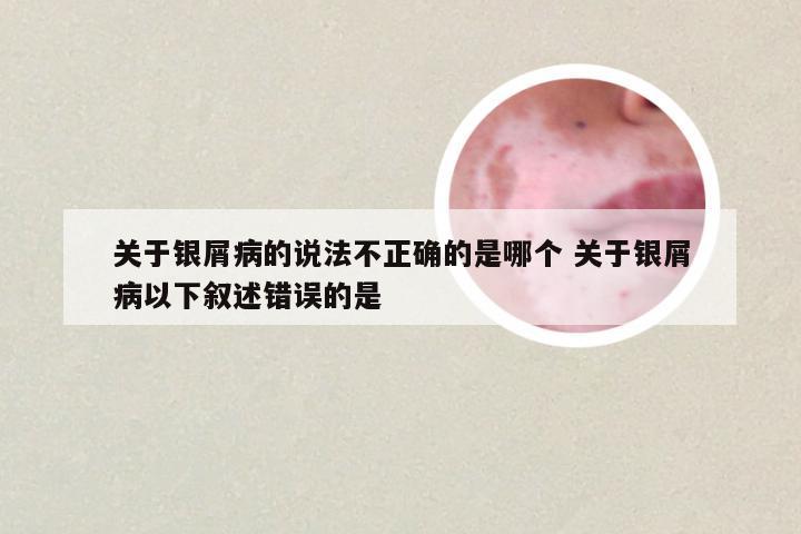关于银屑病的说法不正确的是哪个 关于银屑病以下叙述错误的是