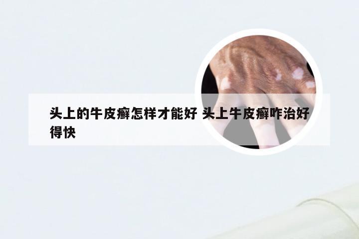 头上的牛皮癣怎样才能好 头上牛皮癣咋治好得快