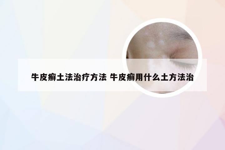 牛皮癣土法治疗方法 牛皮癣用什么土方法治