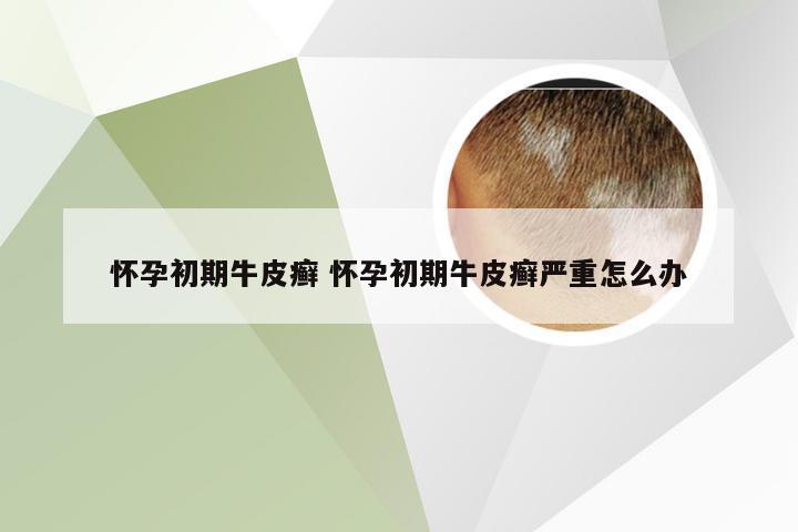 怀孕初期牛皮癣 怀孕初期牛皮癣严重怎么办