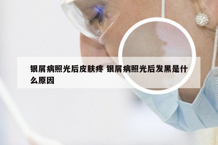 银屑病照光后皮肤疼 银屑病照光后发黑是什么原因