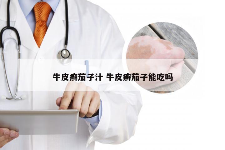 牛皮癣茄子汁 牛皮癣茄子能吃吗