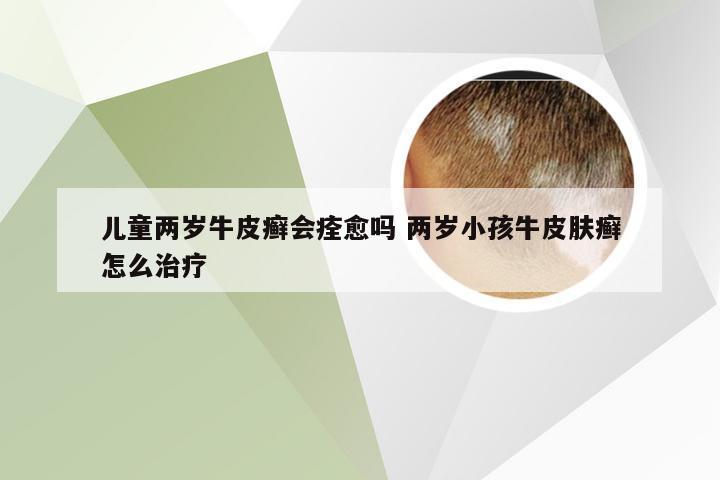 儿童两岁牛皮癣会痊愈吗 两岁小孩牛皮肤癣怎么治疗