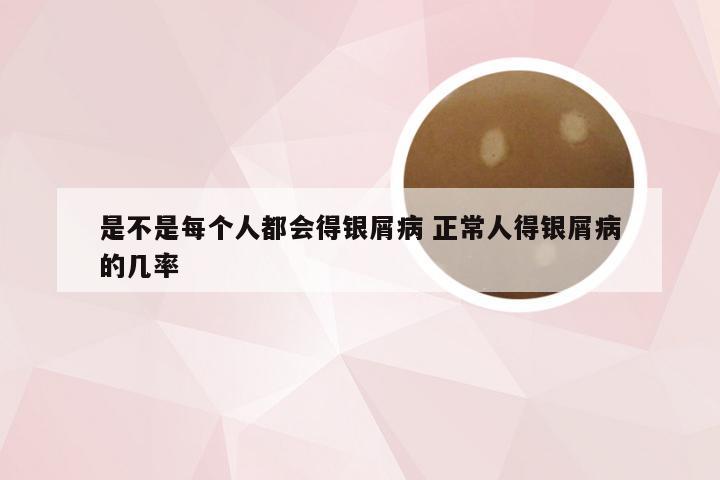 是不是每个人都会得银屑病 正常人得银屑病的几率