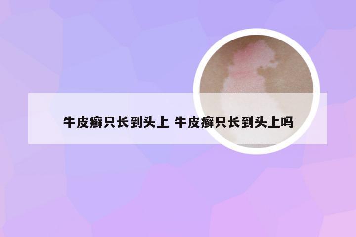 牛皮癣只长到头上 牛皮癣只长到头上吗