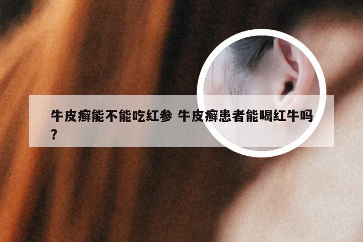 牛皮癣能不能吃红参 牛皮癣患者能喝红牛吗?