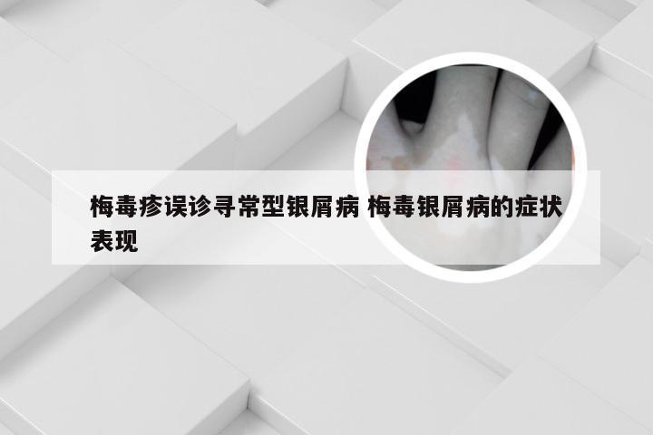梅毒疹误诊寻常型银屑病 梅毒银屑病的症状表现
