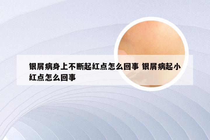 银屑病身上不断起红点怎么回事 银屑病起小红点怎么回事