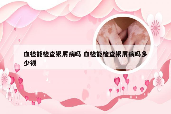血检能检查银屑病吗 血检能检查银屑病吗多少钱