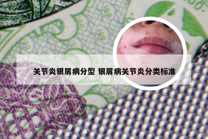 关节炎银屑病分型 银屑病关节炎分类标准