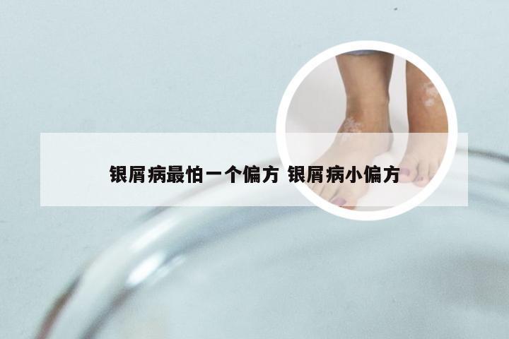 银屑病最怕一个偏方 银屑病小偏方