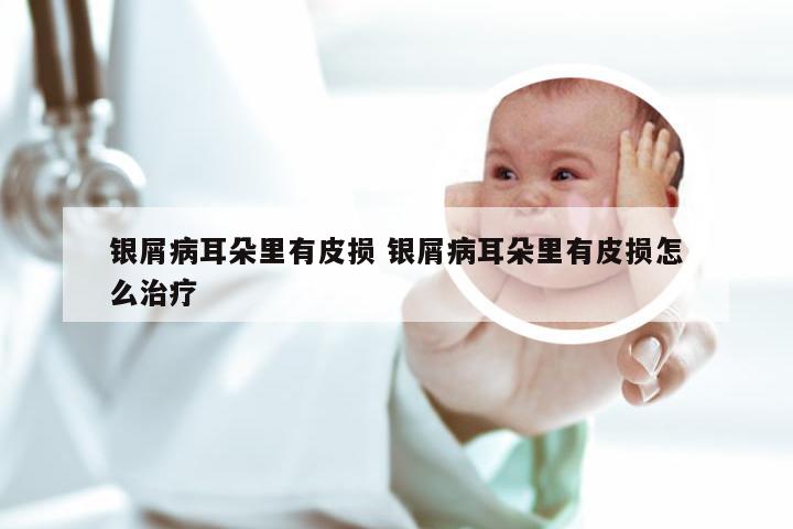 银屑病耳朵里有皮损 银屑病耳朵里有皮损怎么治疗