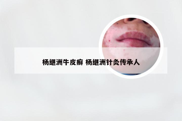 杨继洲牛皮癣 杨继洲针灸传承人