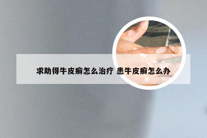 求助得牛皮癣怎么治疗 患牛皮癣怎么办