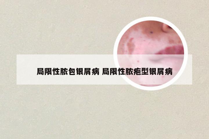 局限性脓包银屑病 局限性脓疱型银屑病