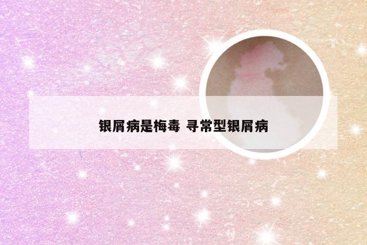 银屑病是梅毒 寻常型银屑病