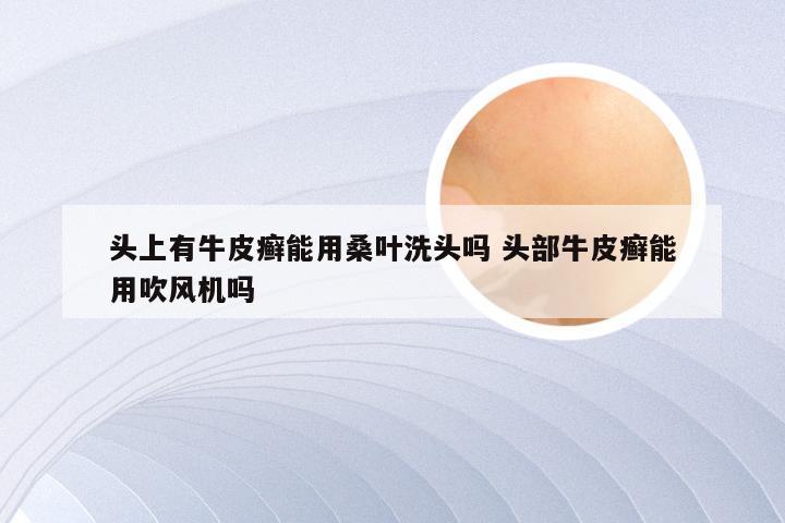 头上有牛皮癣能用桑叶洗头吗 头部牛皮癣能用吹风机吗