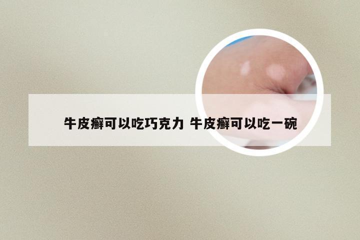 牛皮癣可以吃巧克力 牛皮癣可以吃一碗