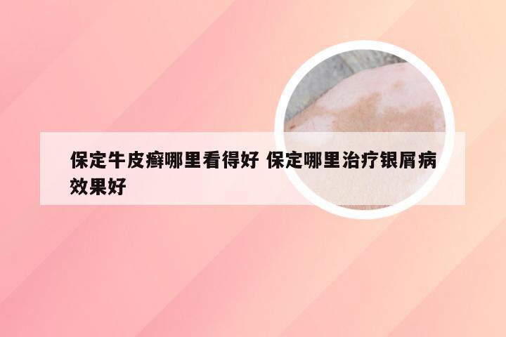 保定牛皮癣哪里看得好 保定哪里治疗银屑病效果好