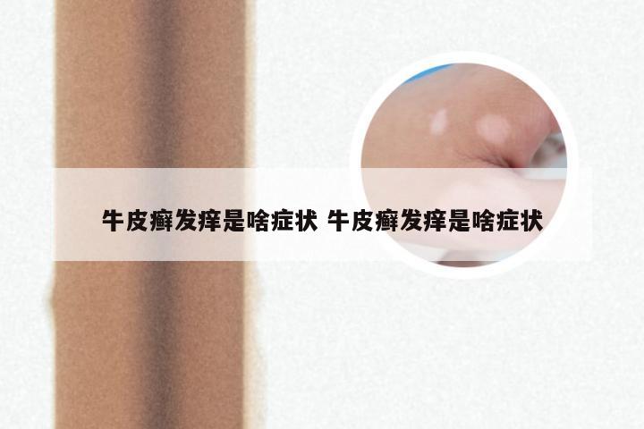 牛皮癣发痒是啥症状 牛皮癣发痒是啥症状