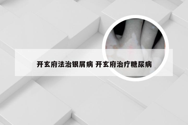 开玄府法治银屑病 开玄府治疗糖尿病