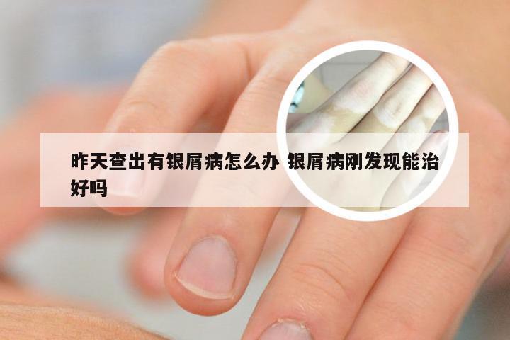 昨天查出有银屑病怎么办 银屑病刚发现能治好吗