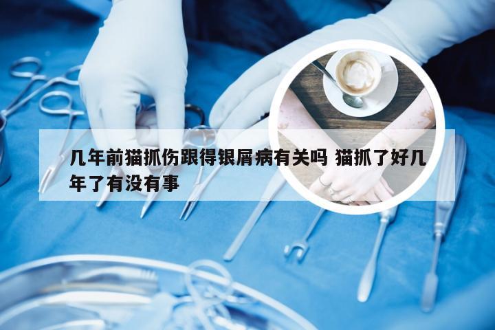 几年前猫抓伤跟得银屑病有关吗 猫抓了好几年了有没有事