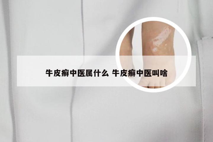 牛皮癣中医属什么 牛皮癣中医叫啥