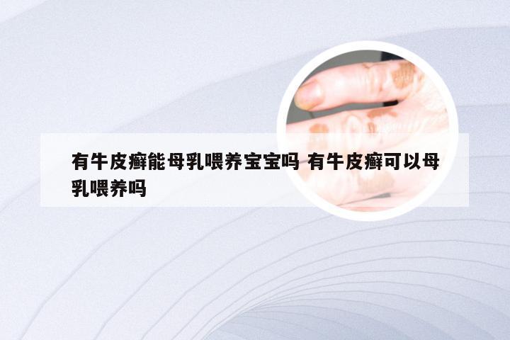 有牛皮癣能母乳喂养宝宝吗 有牛皮癣可以母乳喂养吗
