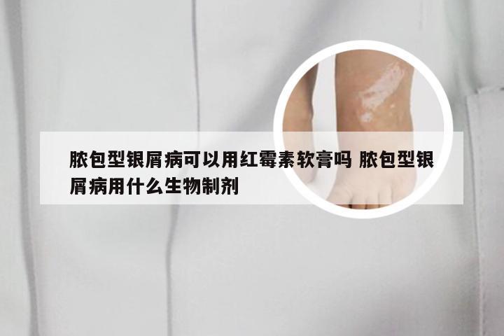 脓包型银屑病可以用红霉素软膏吗 脓包型银屑病用什么生物制剂