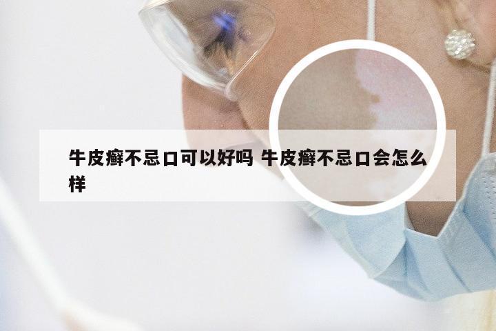 牛皮癣不忌口可以好吗 牛皮癣不忌口会怎么样