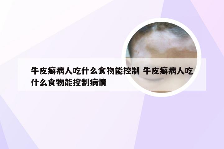 牛皮癣病人吃什么食物能控制 牛皮癣病人吃什么食物能控制病情