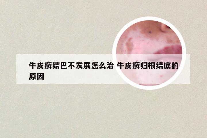 牛皮癣结巴不发展怎么治 牛皮癣归根结底的原因