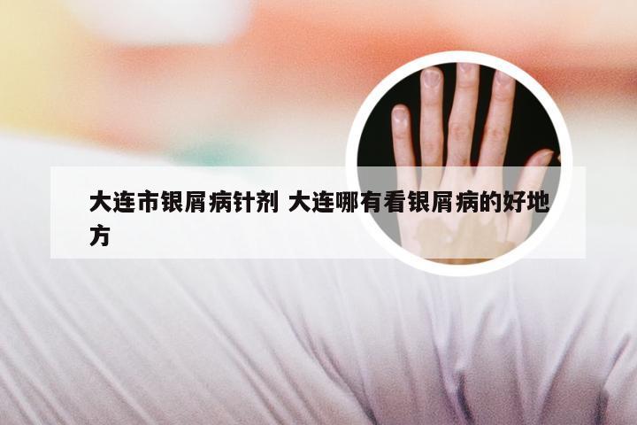 大连市银屑病针剂 大连哪有看银屑病的好地方