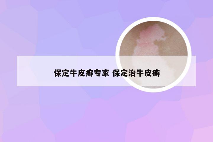 保定牛皮癣专家 保定治牛皮癣